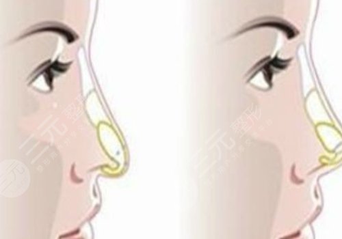 媽生鼻和直鼻微翹的區(qū)別是什么？