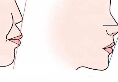 嘴凸是怎么造成的？