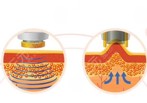 像素射頻儀器祛疤有用嗎？