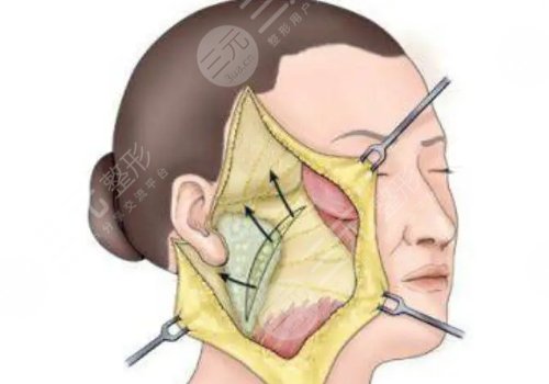 拉皮手術(shù)多大年齡做合適？