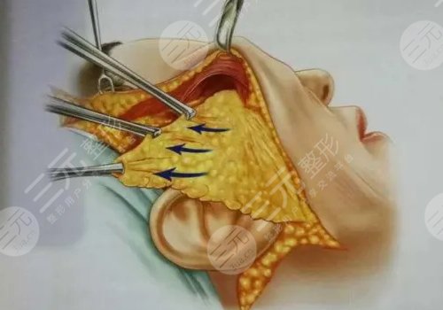 拉皮手術(shù)多大年齡做合適？