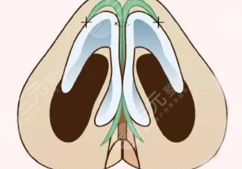 肋骨隆鼻肋骨取了對(duì)身體有影響嗎？