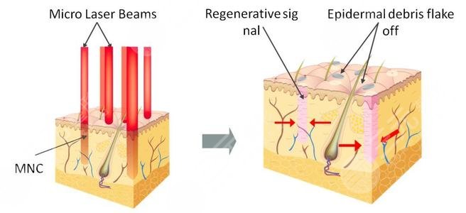像素射頻儀器祛疤有用嗎？