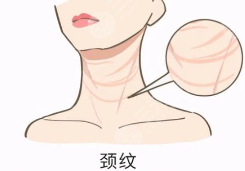 頸紋是什么原因造成的？