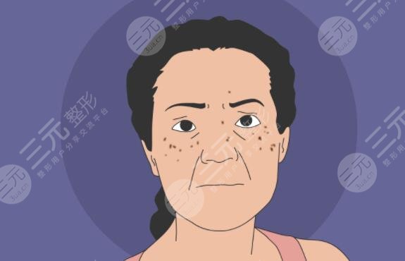 為什么會長有老年斑?