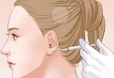 內(nèi)輪廓提升