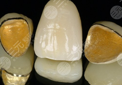 鈦合金烤瓷牙多少錢一顆？