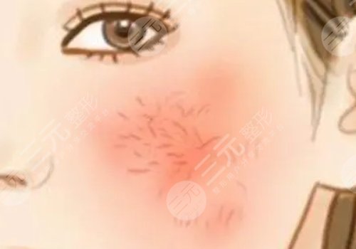 臉上長(zhǎng)紅血絲怎么去掉？