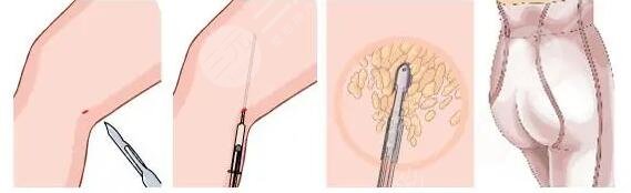 腿部吸脂手術(shù)多少錢一次啊？腿部吸脂手術(shù)潛在的危害有哪些？