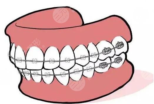 22歲還能矯正牙齒么？需要戴牙套多長時間？大概多少錢？