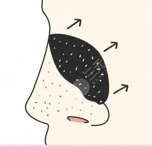 如何收縮鼻頭毛孔粗大小妙招，告別鼻頭黑點(diǎn)點(diǎn)！