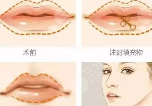 玻尿酸豐唇能維持多久？