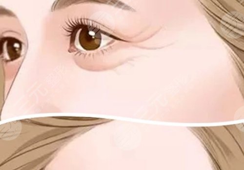 魚尾紋怎么才能去掉？