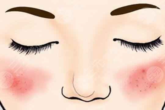 臉上的紅血絲怎么辦呢？快速消除紅血絲小妙招告知！