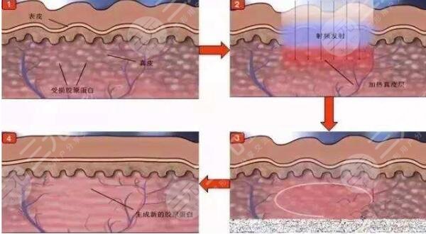 臉上的紅血絲怎么辦呢?