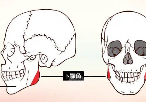 下頜角寬大怎么改良？