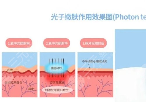 彩光嫩膚和光子嫩膚有什么區(qū)別？