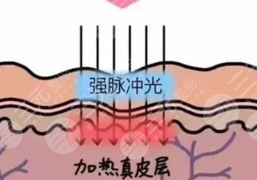 彩光嫩膚和光子嫩膚有什么區(qū)別？