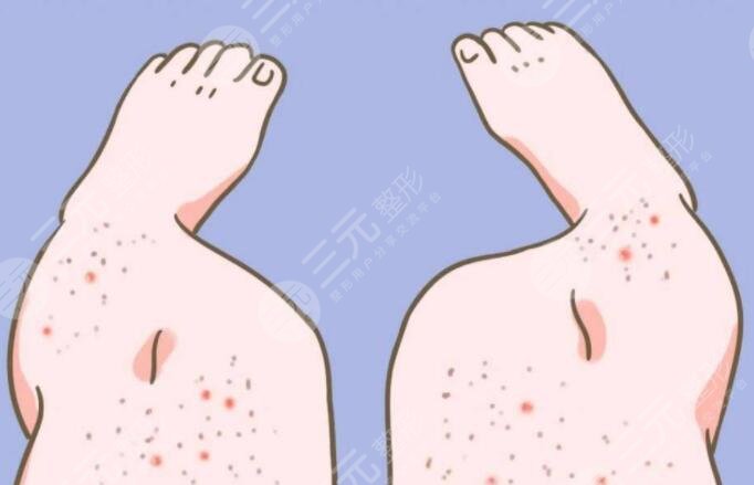 雞皮疙瘩皮膚怎么治比較好？雞皮疙瘩皮膚形成原因及日常護(hù)理