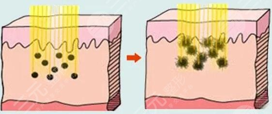 激光嫩膚的作用有哪些?