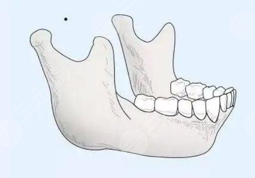 下頜角寬大怎么改良？