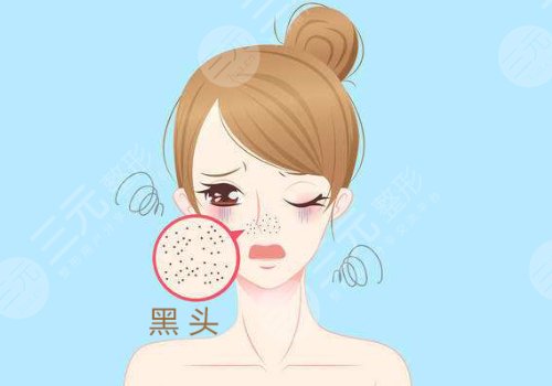 黑頭怎么去除有效？