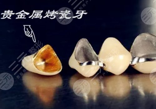 烤瓷牙多少錢一顆？