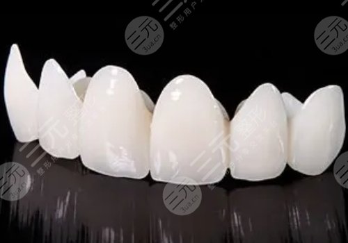 烤瓷牙多少錢一顆？