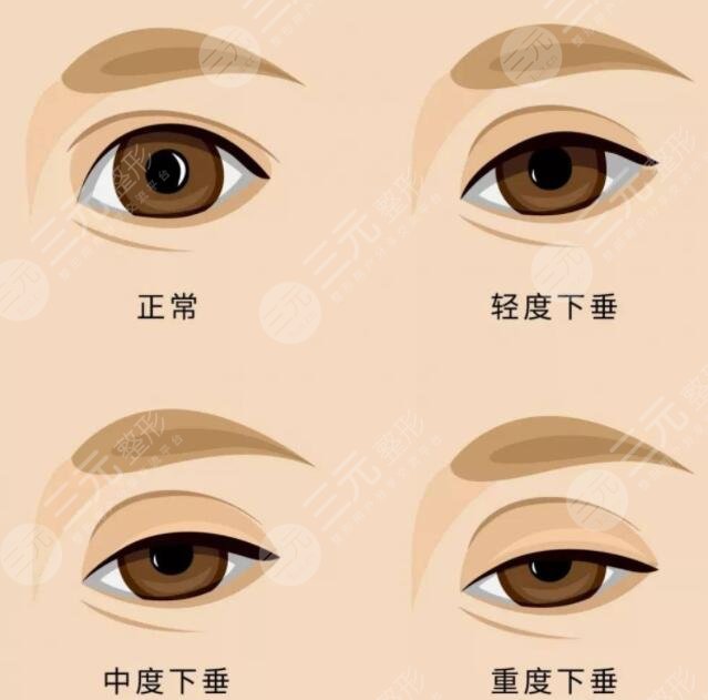 上瞼下垂矯正手術(shù)一般多少錢？價格決定因素有2點！