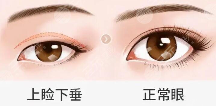 上瞼下垂矯正手術(shù)一般多少錢?