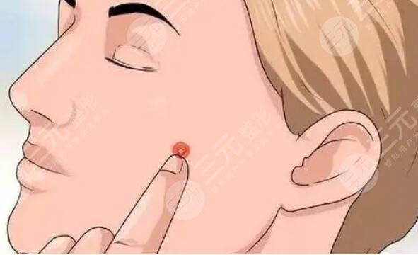 臉上紅色痘印怎么消除？光子嫩膚是好選擇！原理及功效可查！