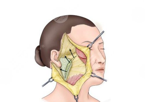拉皮手術(shù)多大年齡做合適？
