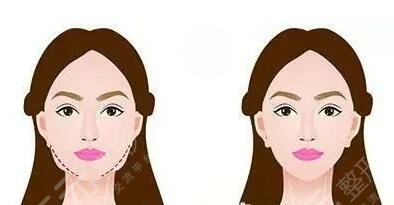 下頜角整形手術(shù)