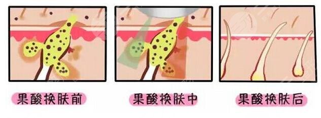 果酸換膚好不好怎么看?