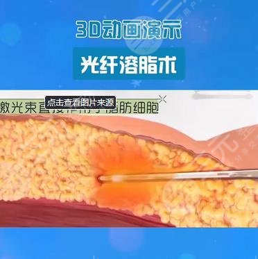 光纖溶脂的危害有哪些