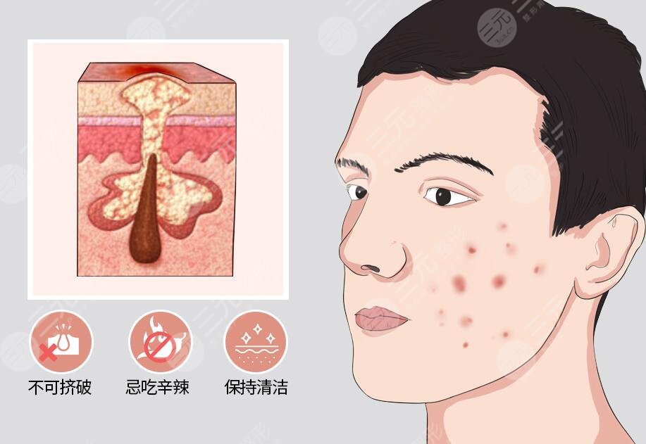 紅藍(lán)光祛痘效果好嗎?