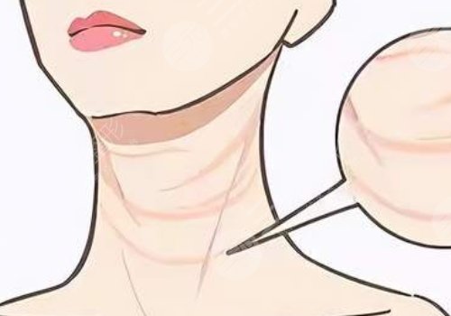 頸紋填充能維持多久呢？色素沉著能消退嗎？