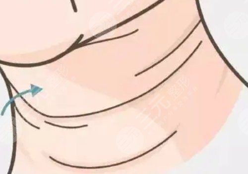 頸紋填充能維持多久呢？色素沉著能消退嗎？