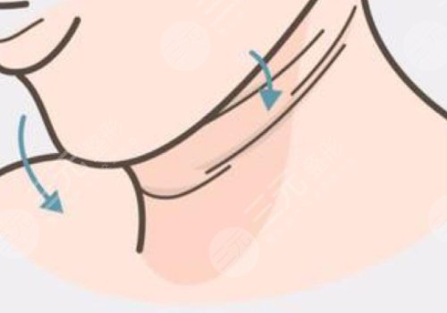 頸紋填充能維持多久呢？色素沉著能消退嗎？