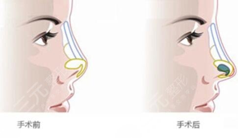 膨體隆鼻大概需要多少錢?