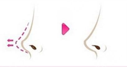 膨體隆鼻如何護(hù)理?