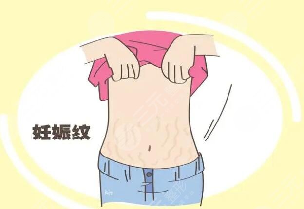 橄欖油去除妊娠紋需要配合使用身體乳嘛？使用方法