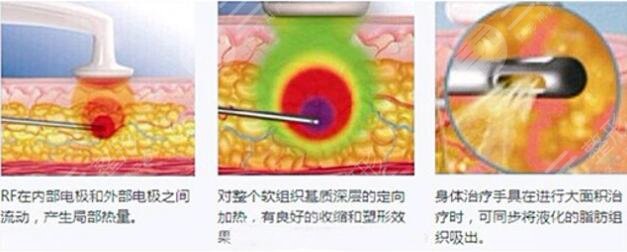 光纖溶脂優(yōu)勢：