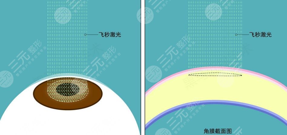 近視眼矯正的方法有哪些