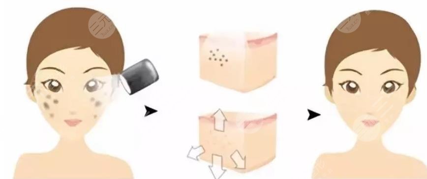 復(fù)合彩光緩解多少錢