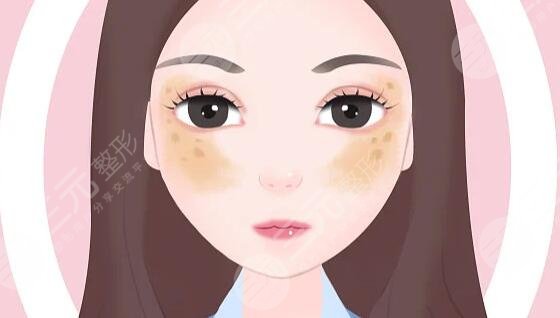 去除黃褐斑價格大概是多少?