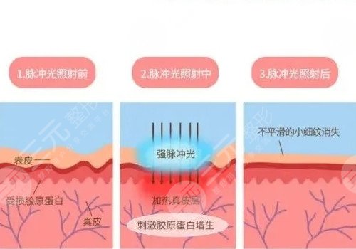 深藍(lán)射頻和熱拉提的區(qū)別