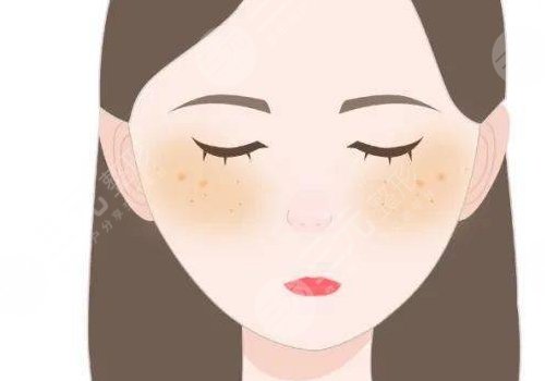 激光祛斑會不會反彈？