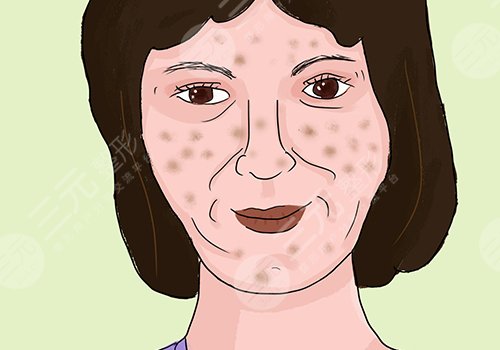 激光祛斑會不會反彈？