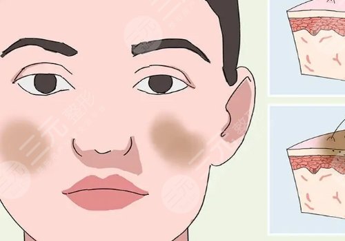 激光祛斑會不會反彈？